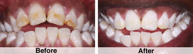 Fluorosis and Microabrasion - Kawana Dental Sunshine Coast