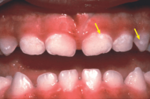 White Spots on Teeth: In Children, While Sick, and More