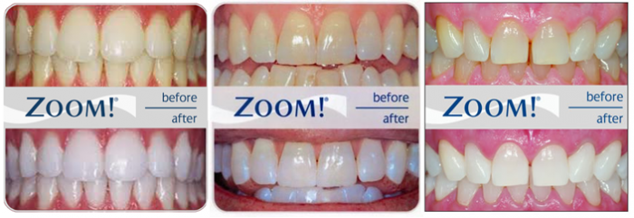 How much does teeth whitening cost? - Kawana Dental ...